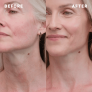 High Profile Neck Treatment