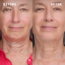 High Profile Neck Treatment
